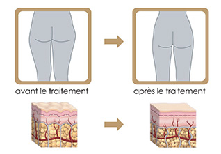 La lipocavitation – Image 2