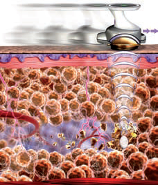 La lipocavitation – Image 3