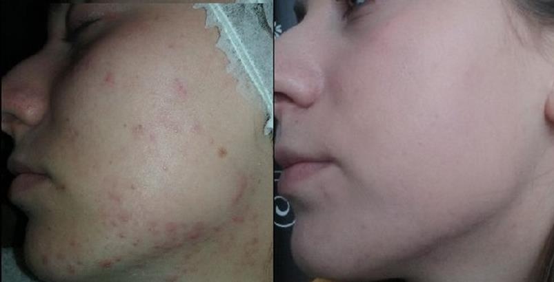 Réti Fusion Peel – Image 3