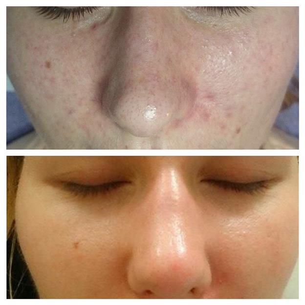 Réti Fusion Peel – Image 2